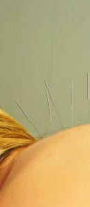 Acupuncture needles applied to the back